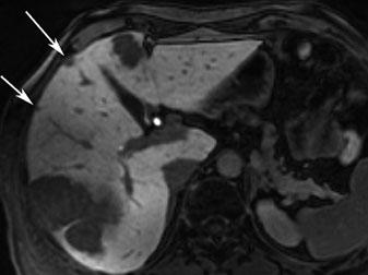 There is a subtle hypointensity in the right lobe in a subcapsular location. b DWI clearly shows an additional metastasis (arrows) a b [67] (Fig. 20).