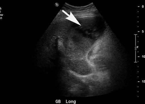 a Longitudinal ultrasound (US) shows a distended gallbladder containing sludge and intraluminal
