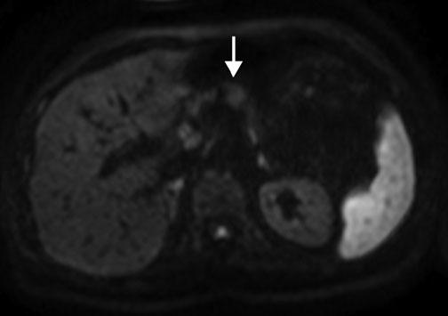 d On axial diffusion-weighted image (DWI) (b=1000) the neuroendocrine neoplasm shows restricted diffusion (arrow) e pithelial cysts, primary lymphoma) and secondary tumors (secondary lymphoma,
