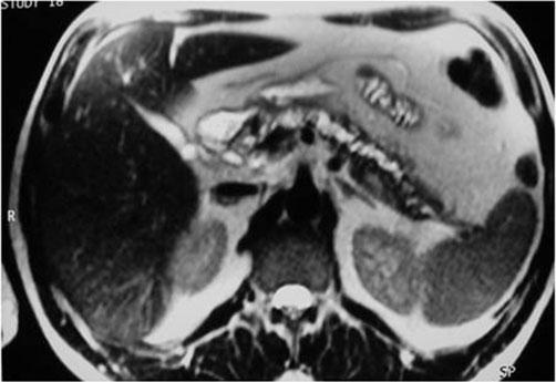 Note the similar imaging appearance to other cystic lesions of the pancreas and common bile duct), and autoimmune pancreatitis (AIP)[26-29].