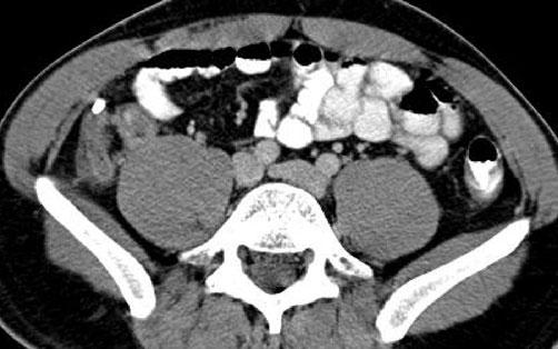 pericolonic inflammatory changes. Localized inflammation may be substantial. When considering a diagnosis of cecal diverticulitis, it is important to identify a normal appendix.