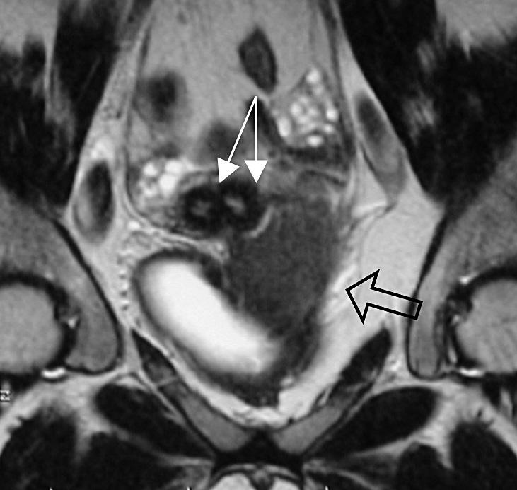 A transverse left hemivaginal septum obstructs the ipsilateral vagina, leading to left hematocolpos (open arrow, b) ratio are preserved in both horns.