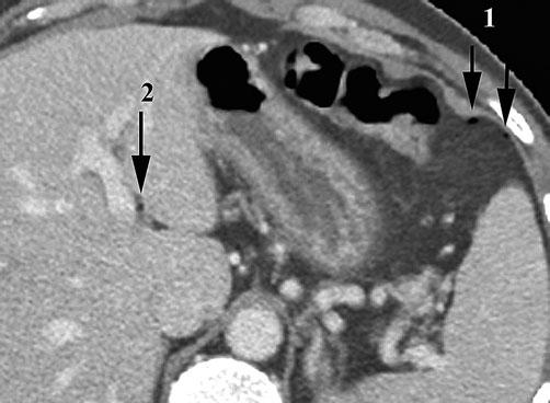 Emergency Radiology of the Abdomen and Pelvis: Imaging of the Nontraumatic and Traumatic Acute Abdomen 9 a b Fig. 7 a, b. Perforated sigmoid diverticulitis.