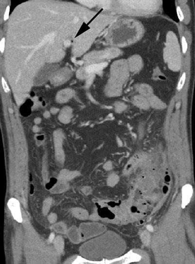 b Coronal CT reformation shows thickened sigmoid colon, with associated diverticular disease, inflammation of the adjacent fat, and thickening of the root of the sigmoid mesocolon.