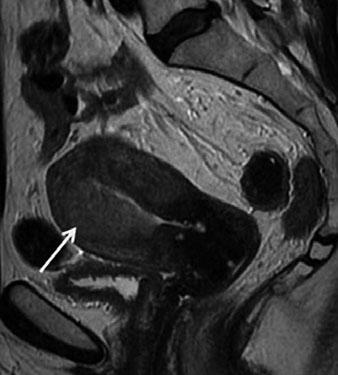arrow), as well as vaginal drop involvement (dashed arrow) of normal rim of enhancement of outer myometrium on CE T1-WI indicates serosal involvement.