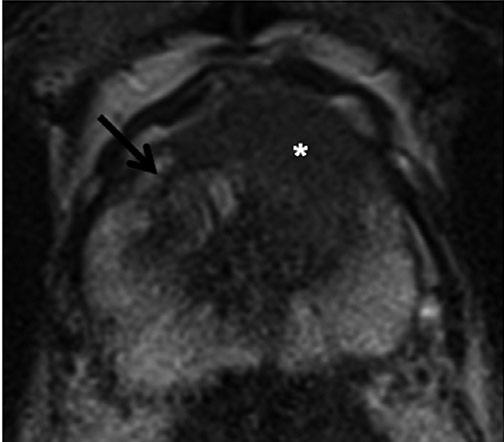 After targeted biopsy under magnetic resonance imaging (MRI) guidance, an acinar prostate adenocarcinoma with a Gleason score of 3 4 7 was detected.