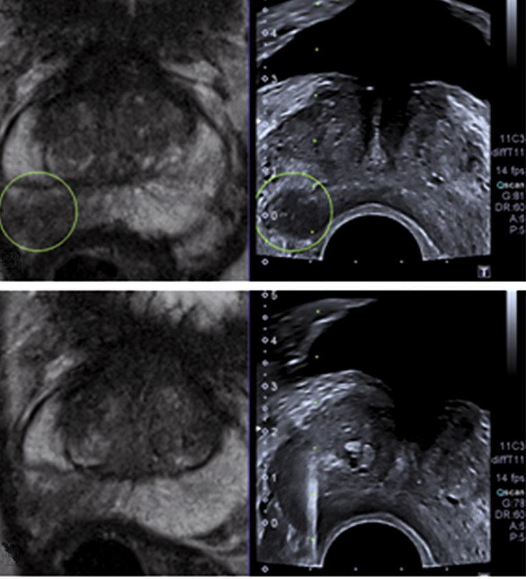 186 T. Durmus, A. Baur, B. Hamm Fig. 10 a, b. Magnetic resonance imaging (MRI)-ultrasound (US) 3D fusion in real time.