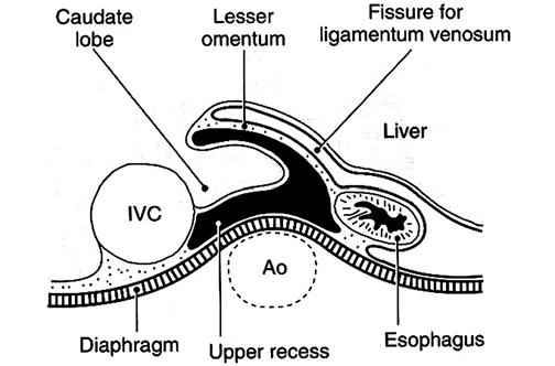 Pathways for the Spread of Disease in the Abdomen and Pelvis 209 Lesser Sac The lesser sac is comprised of superior and inferior recesses [10, 20].