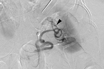 visualized in b portal-venous-phase CT. c Selective splenic angiogram confirms pseudoaneurysm formation (arrowhead) in the upper pole of the spleen.