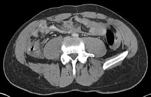 A 53-year-old male patient after blunt abdominal trauma showing an oval hematoma expanding the right adrenal gland (arrow) on computed tomography (CT) with a mean attenuation of 50 HU