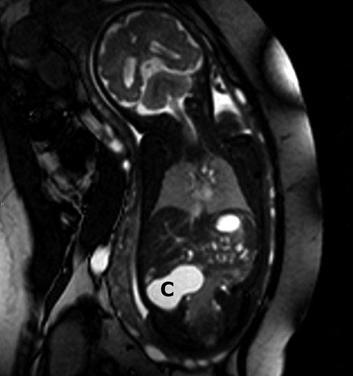 Congenital and Acquired Pathologies of the Pediatric Gastrointestinal Tract 219 a b Fig. 3 a, b. Duplication cyst of ileum.