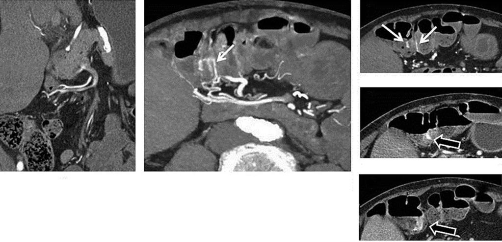 28 J.G. Fletcher with overt-type OGIB and those with nondiagnostic capsule endoscopy findings. The diagnostic yield of CT enterography in occult obscure GI bleeding is low.