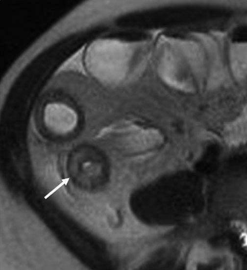 34 K.A. Herrmann a b Fig. 1 a, b. Active Crohn s disease: magnetic resonance (MR) enteroclysis.