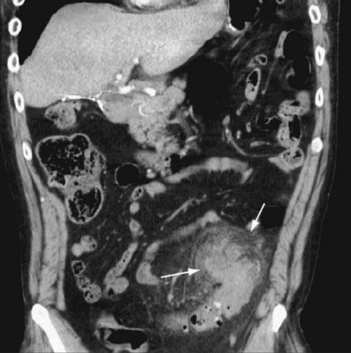 Infectious, Inflammatory, and Ischemic Diseases of the Colon and Rectum 39 enhancement during the arterial phase of contrast administration.