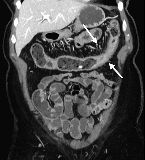 42 R.M. Gore, R. Silvers Rectal narrowing and widening of the presacral space are hallmarks of chronic ulcerative colitis.