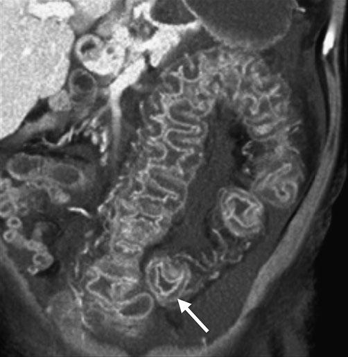 Infectious, Inflammatory, and Ischemic Diseases of the Colon and Rectum 43 This diagnostic dilemma is further complicated by the fact that many patients are receiving immunosuppressive therapy, which