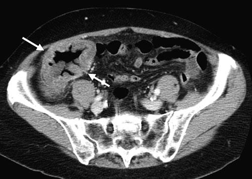 44 R.M. Gore, R. Silvers bowel disease. Submucosal fat deposition on CT is primarily found in subacute and chronic colitides, usually ulcerative colitis, and not in acute disease. References Fig. 9.