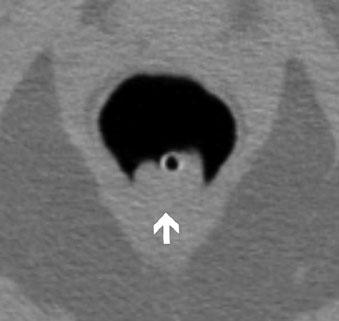 b Corresponding 2D image shows internal hemorrhoids with soft issue attenuation surrounding the rectal catheter (white arrow) a b Fig. 3 a, b.