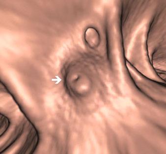 c The 3D view of the same segment in supine position shows two normal diverticula: the polypoid lesion with the central depression has become a diverticulum: inverted diverticulum (white arrow)