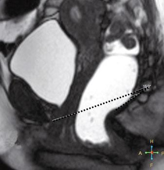 How to Perform and Report Magnetic Resonance Imaging for Pelvic Floor Dysfunction: An Interactive Case-Based Approach 65 Other measurements in the sagittal plane during maximum straining include: The