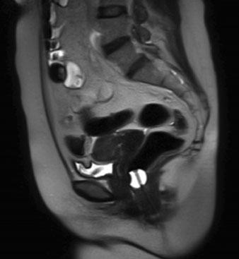 b Sagittal T2- weighted image during contraction of the pelvic floor: the ARA reduces to 90.