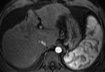 Additional imaging features are: (1) focal retraction of the liver capsule over the area of fibrosis, (2) incomplete involvement of liver segments with accompanying atrophy, and (3) characteristic