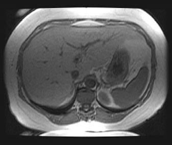 b In-phase and c out-of-phase T1-weighted images show significant signal drop in the liver on the out-of-phase images.