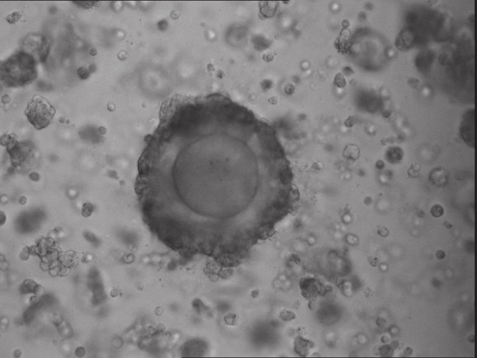 (a) MII-stage oocyte with clumped corona radiata.