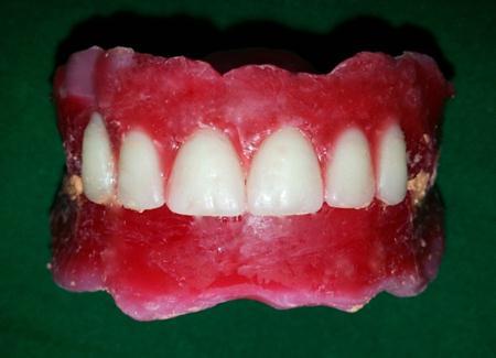 Following the establishment of the maxillary occlusal plane, mandibular temporary denture base was inserted in the mouth, and the mandibular occlusal plane was adjusted to the maxillary occlusal