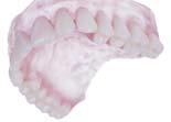 This denture utilizes a series of tiny suction cups made from a soft silicone rubber that gently