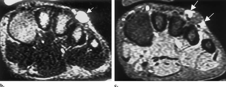 (long arrows in a). (c) On a coronal gadolinium-enhanced fat-suppressed T1-weighted MR image, the mass demonstrates low signal intensity with peripheral enhancement (arrows). Figure 14.