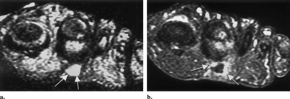 (b) On a coronal gadolinium-enhanced fat-suppressed T1-weighted MR image, the mass demonstrates low signal intensity with peripheral enhancement (arrows).