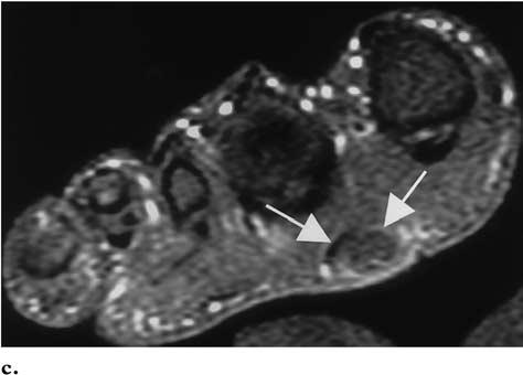 A channel communicating with the skin surface is also seen (short arrows). (b) On a coronal T2-weighted MR image, the lesion demonstrates low signal intensity (arrows).