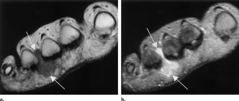 RG f Volume 21 Number 6 Ashman et al 1437 Figure 16. Morton neuroma in a patient with pain at the level of the third MTP joint radiating into the toe.