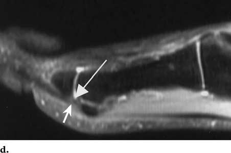 (b) Sagittal short-inversion-time inversion recovery (STIR) MR image demonstrates edema in the region of the plantar plate (arrow).
