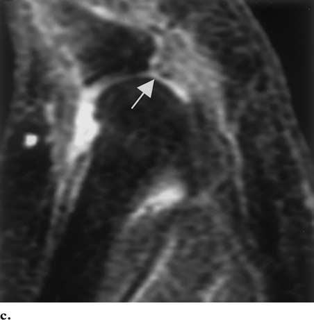 (b, c) Sagittal gadolinium-enhanced fat-suppressed T1-weighted MR images obtained at the medial (b) and lateral (c) aspects of the second MTP joint show a thin, irregular, indistinct plantar plate