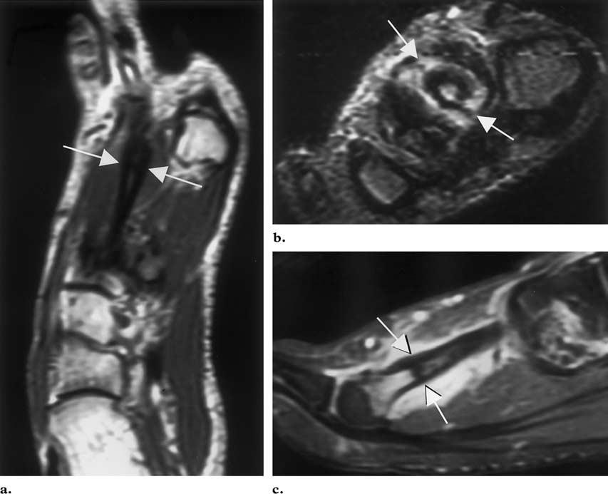 RG f Volume 21 Number 6 Ashman et al 1429 Figure 4. Stress fracture of the second metatarsal shaft in a 19-year-old male runner. The patient had no history of acute trauma.