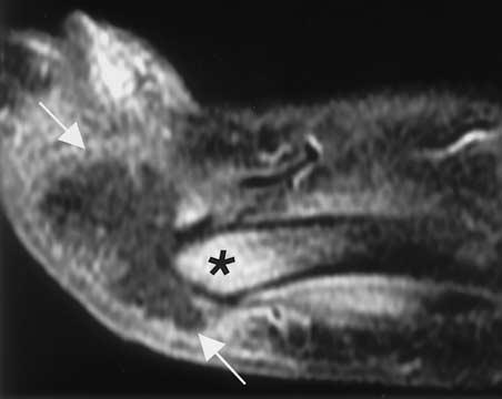 (a) Axial T1-weighted MR image shows an area of diffuse low signal intensity within the marrow of the distal first metatarsal bone (arrows).