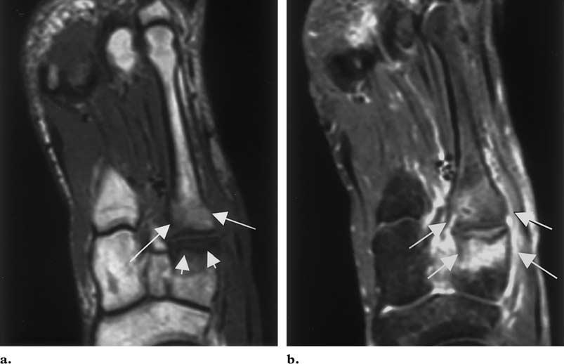 RG f Volume 21 Number 6 Ashman et al 1431 Figure 7. Early neuropathic osteoarthropathy in a 49-year-old diabetic man who complained of foot pain and swelling.