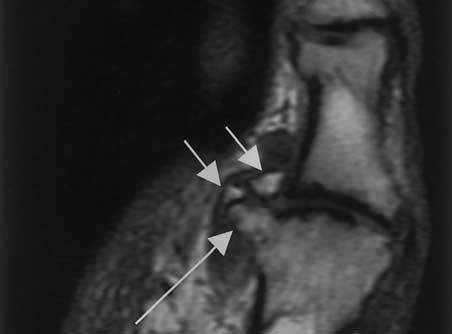 1432 November-December 2001 RG f Volume 21 Number 6 Figure 8. Osteoarthritis at the first MTP joint in a 50-year-old man.