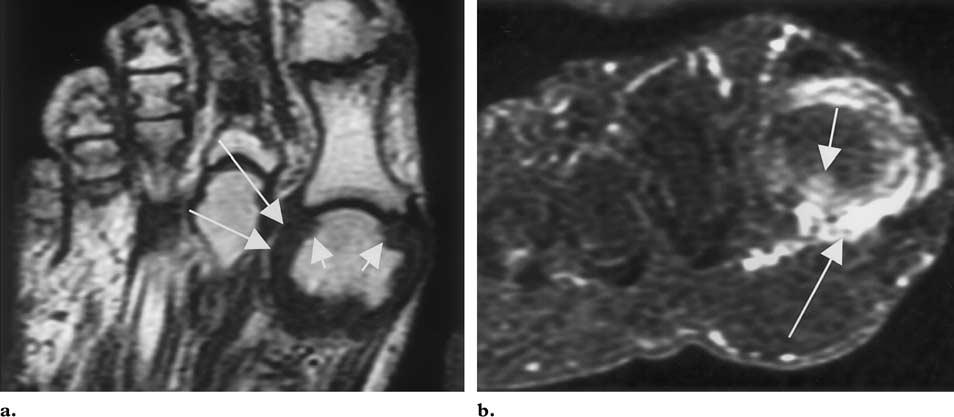 RG f Volume 21 Number 6 Ashman et al 1433 Figure 10. Rheumatoid arthritis in a 71-year-old woman with pain at the first MTP joint.