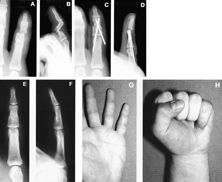 6. PRIJELOMI FALANGI PRSTIJU ŠAKE Ozljede prstiju često se smatraju nevažnim, iako, ako se pravovremeno i pravilno ne liječe mogu izazvati velike probleme. Slika 11.
