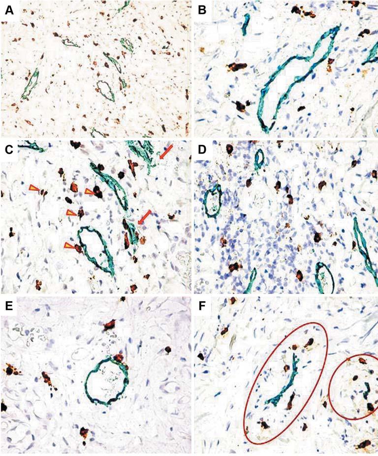 Figure 1. A hot-spot field used to count mast cells and lymphatic vessels (A, 200).