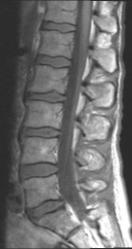 Fundmentls of Spine MRI nd Essentil Protocols A. C. Dougls-Akinwnde, MD Octoer 13, 2009 Fundmentls of Spine MRI Lerning Ojectives: 1. List the essentil sequences for Spine MRI exmintion 2.