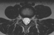 Discuss how different MR imging sequences nd techniques cn e implemented to reduce metl relted rtifcts. Outline A. Typicl sequences on Spine MRI 1. Sgittl nd Axil T1 2. Sgittl nd Axil T2 3.