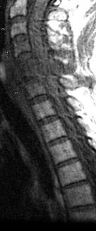 Spine MRI Cncer / Infection