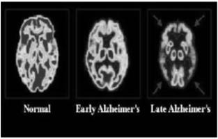 AD is a Neurodegenerative Disease as Seen in the PET Scan and is Characterized by Amyloid Plaques and Neurofibrillary Tangles Mild Cognitive Impairment or Mild Neurocognitive Disorder: Implications