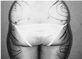 These views show the result of liposuction of the lateral thighs, abdomen, waist and flanks. These views show the results of liposuction of the hips and outer thighs.