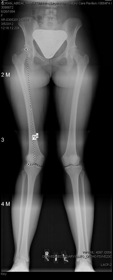 Results Valgus Correction: Avg pre-op lateral distal