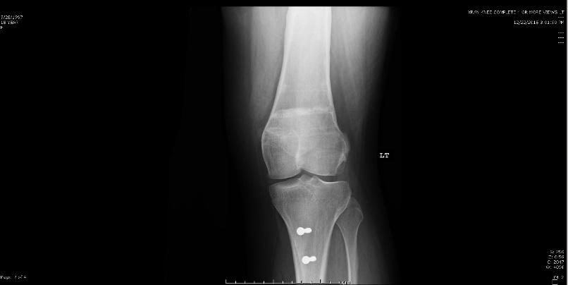 Results - Failures 2/10 (20%) Recurrent Patello-femoral subluxation symptoms One underwent a TTT osteotomy with a MPFL reconstruction One elected
